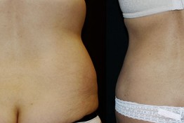 Liposuction Muffin Top