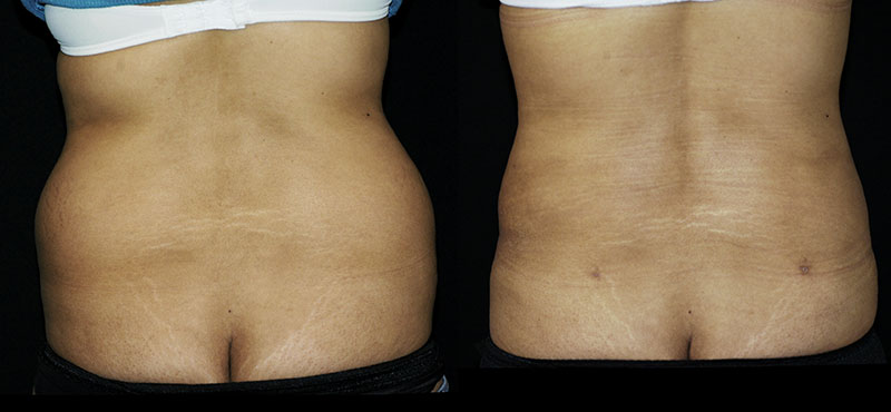 Liposuction Muffin Top