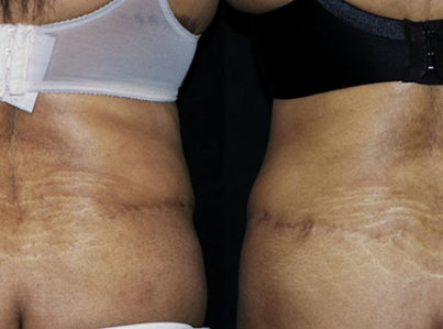 Liposuction Muffin Top