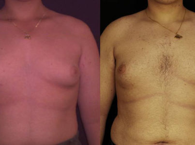 Male Breast Reduction Gynecomastia1