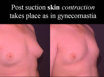 Male Breast Reduction Gynecomastia