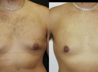 Male Breast Reduction Gynecomastia