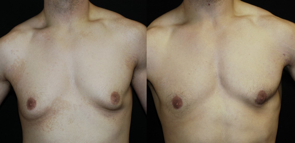 Male Breast Reduction Gynecomastia