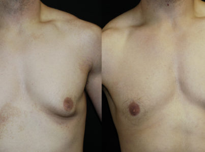 Male Breast Reduction Gynecomastia