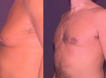 Male Breast Reduction Gynecomastia5