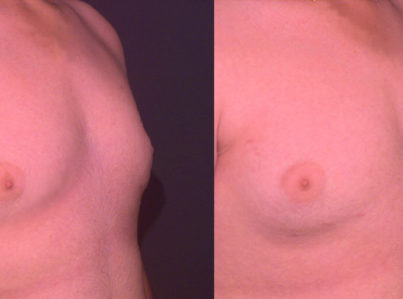 Male Breast Reduction Gynecomastia