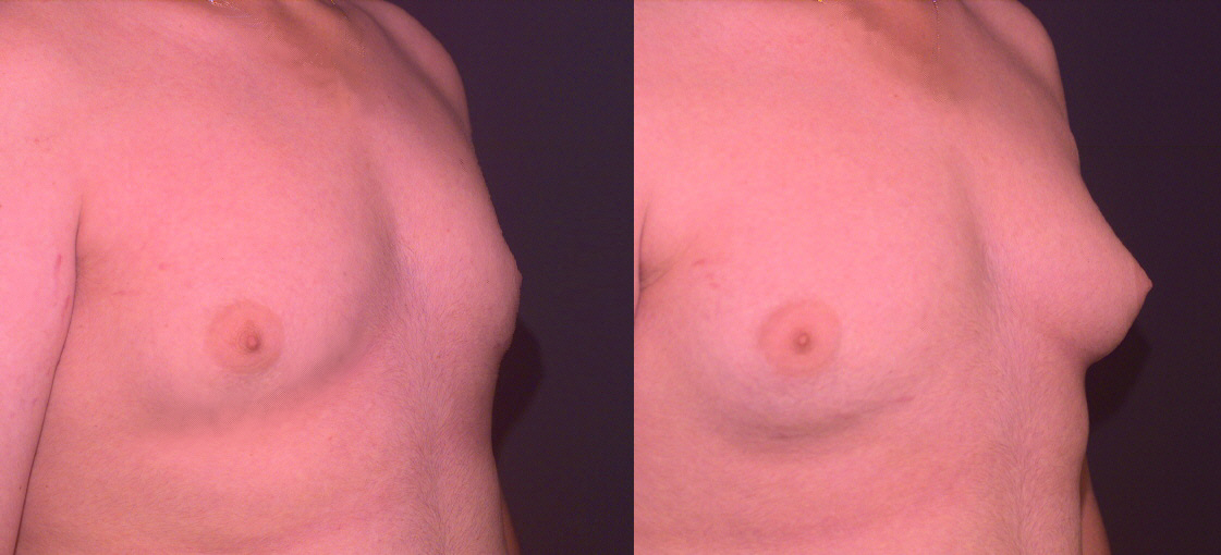 Male Breast Reduction Gynecomastia