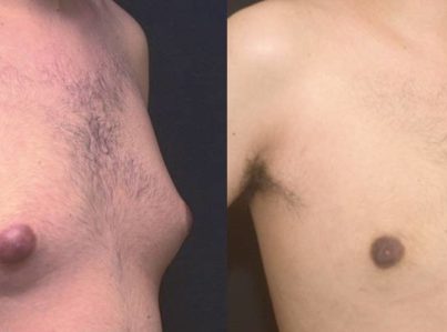 Male Breast Reduction Gynecomastia