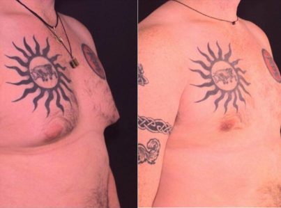 Male Breast Reduction Gynecomastia