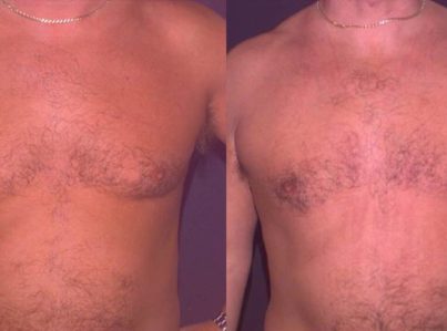 Male Breast Reduction Gynecomastia