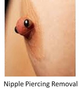 Nipple Piercing Removal