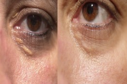 Xanthelasma Surgery