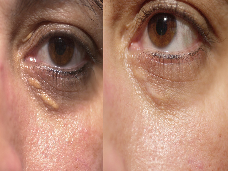 Xanthelasma Surgery