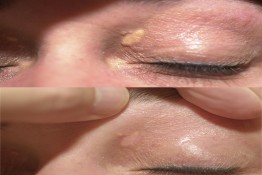 Xanthelasma Surgery