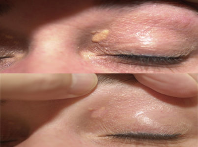 Xanthelasma Surgery