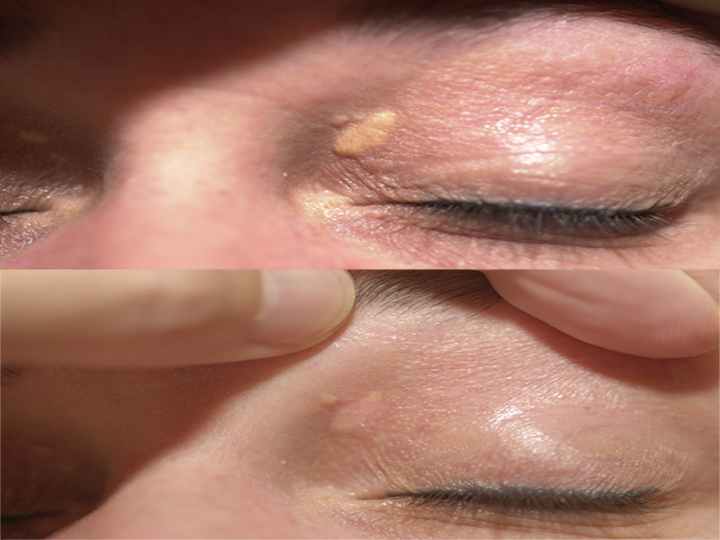 Xanthelasma Surgery