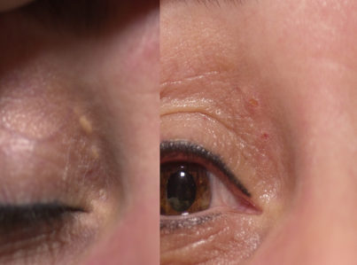 Xanthelasma Surgery