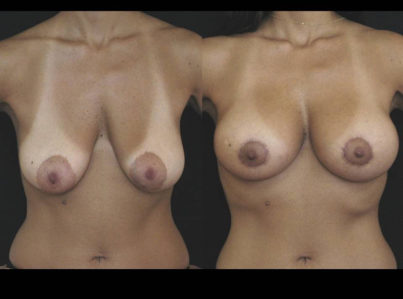 breast lift mastopexy