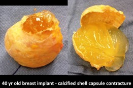 Correction of Implant Problems Performed by Another Surgeon