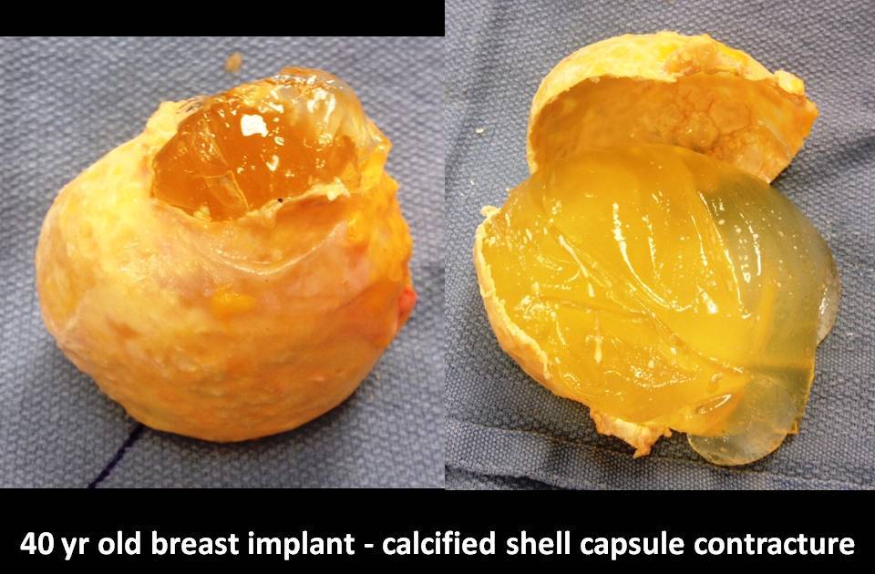 Correction of Implant Problems Performed by Another Surgeon