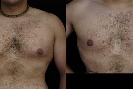 Male Breast Reduction Gynecomastia