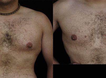 Male Breast Reduction Gynecomastia