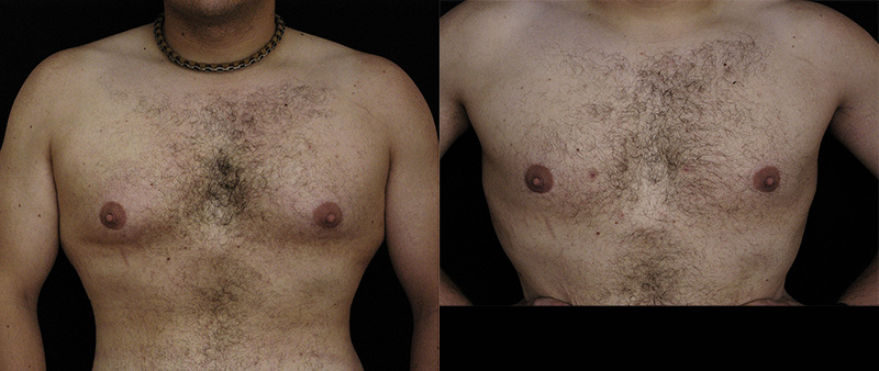 Male Breast Reduction Gynecomastia