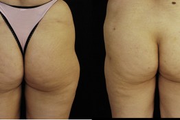 lateral thigh liposuction