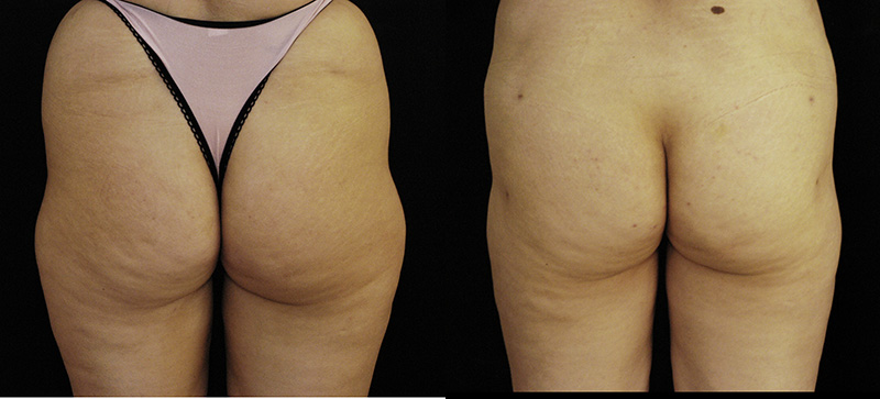 lateral thigh liposuction