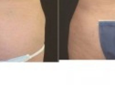 Liposuction-Muffin-Top-Hips14-960x300_c