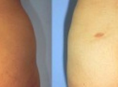 Liposuction-Muffin-Top-Hips16-960x300_c