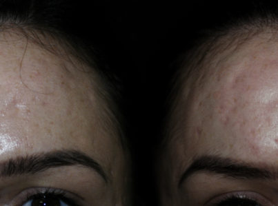 Acne Scar Subcision with Fat graft Before and After