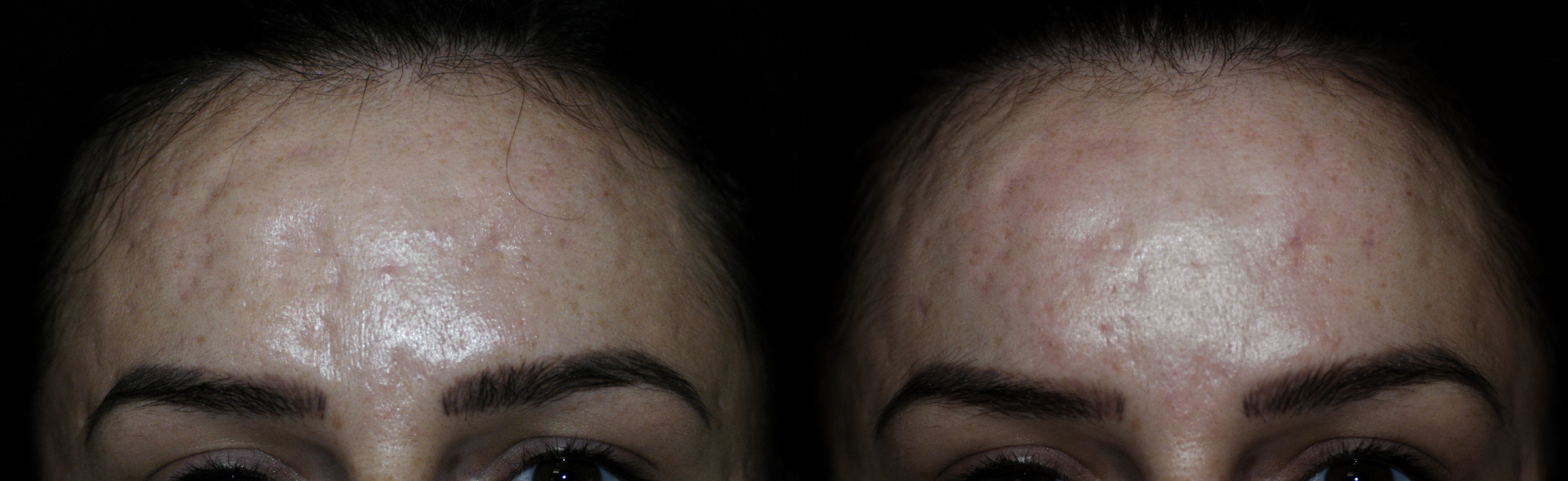 Acne Scar Subcision with Fat graft Before and After