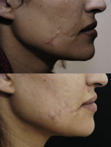Before and after scar revision