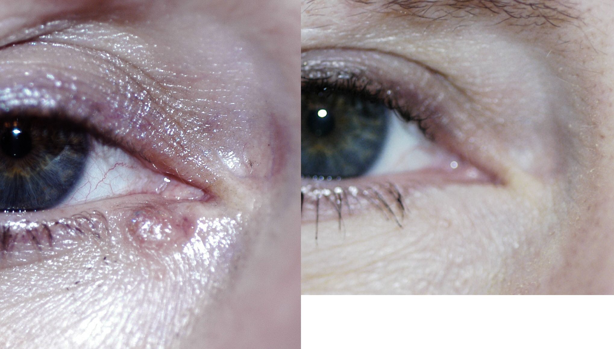 eyelid tumor removal