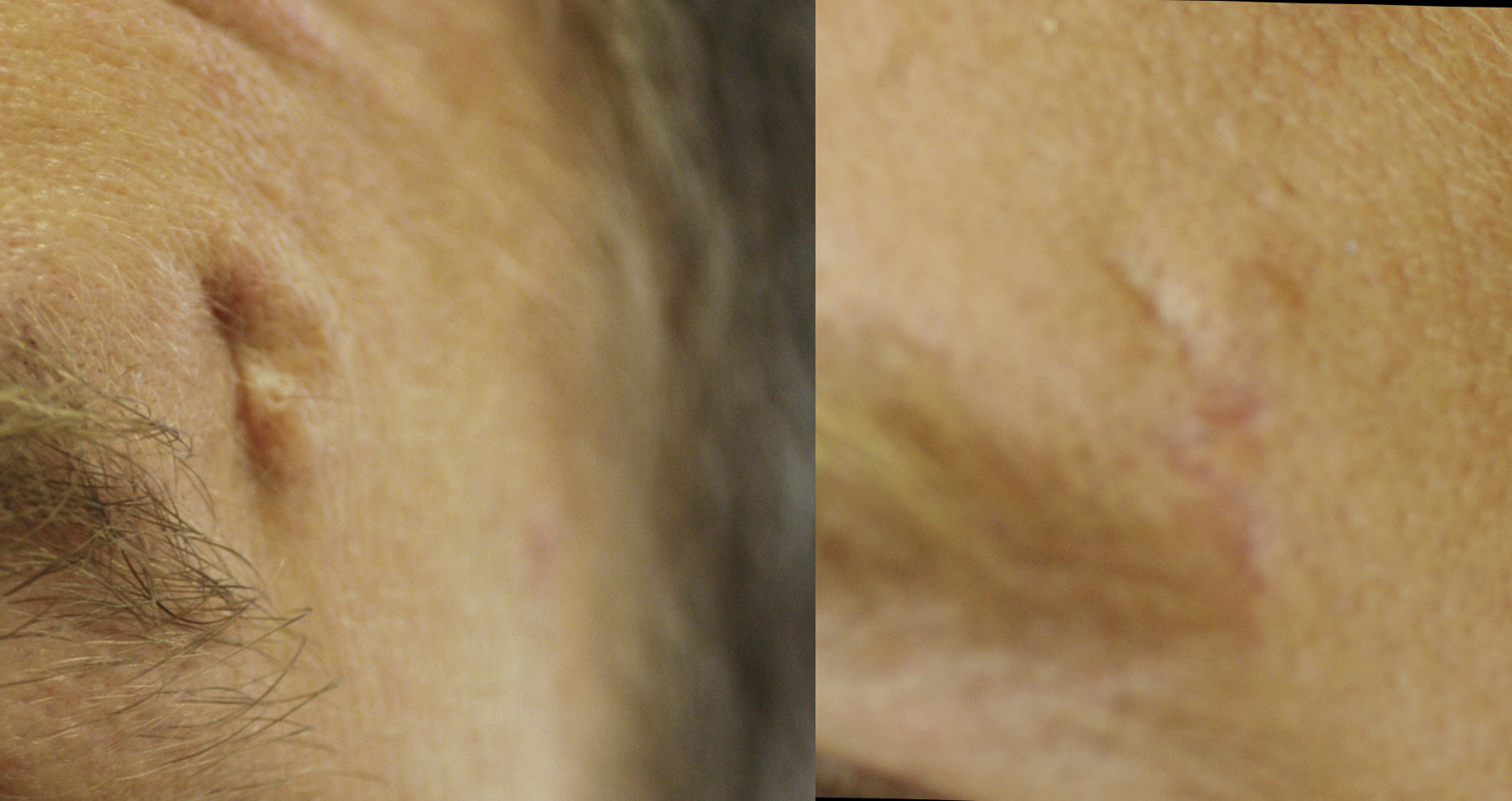 Scar Revision before and after