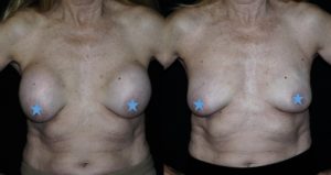 breast implant removal surgery