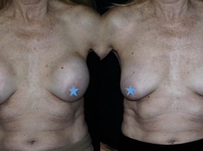 breast implant removal surgery