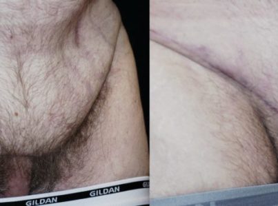 FUPA Hidden penis correction before and after