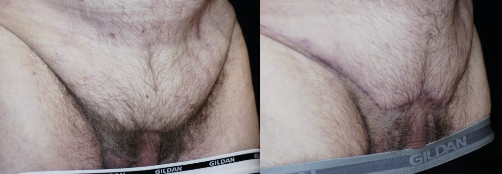 FUPA Hidden penis correction before and after