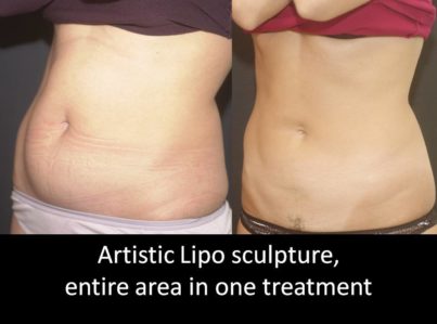 Artistic-Lipo-sculpture