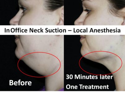 Neck-suction