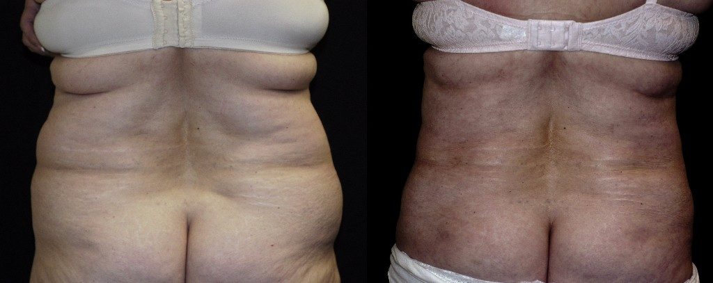 Bra Rolls Back Fat - Sadove Cosmetic Surgery