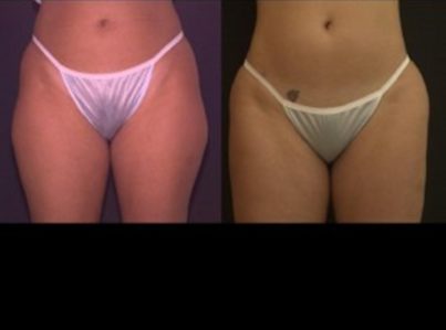 liposuction-12-300x225-1-1