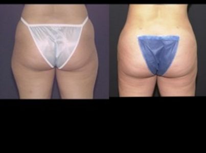 liposuction-13-300x225-1