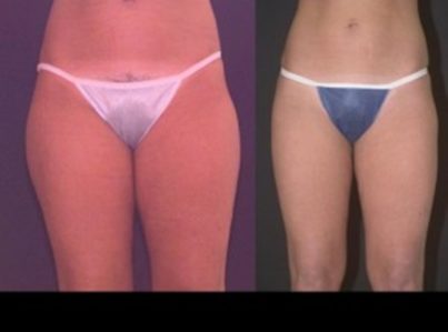 liposuction-14-300x225-1-1