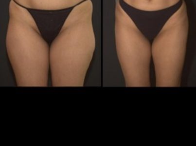 liposuction-15-300x225-1-1