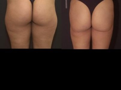 liposuction-16-300x225-1