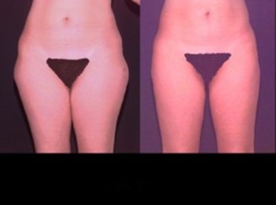 liposuction-4-300x225-1-1
