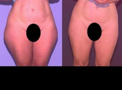 liposuction-6-300x225-1